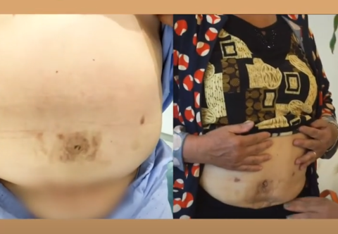 Giảm 20kg bệnh nhân U60  tạm biệt xương khớp, mỡ máu đeo bám